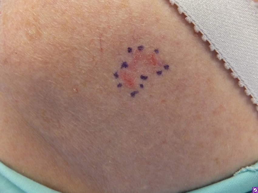 Figure 2 A, Superficial basal cell carcinoma
